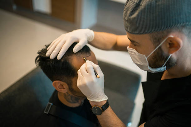 Does FUE Hair Transplant Give Natural Results