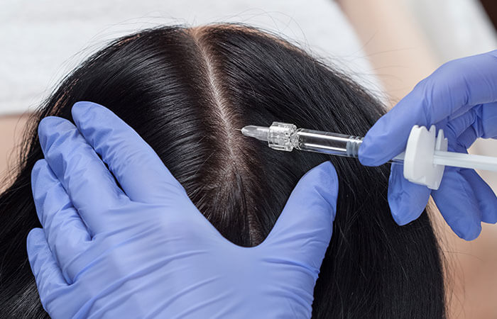 Does Hair Fillers Treatment Really Boost Hair Growth