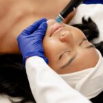 Does HydraFacial Reduce Acne And Blackheads