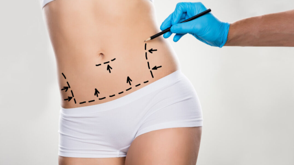 Does Lipo Abdominoplasty Reduce Belly Fat Permanently