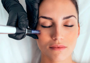 Does Microneedling Reduce Fine Lines Effectively