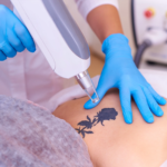 Does Picosure Tattoo Removal Completely Erase Tattoos