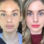 Radiofrequency Microneedling treatment in Dubai