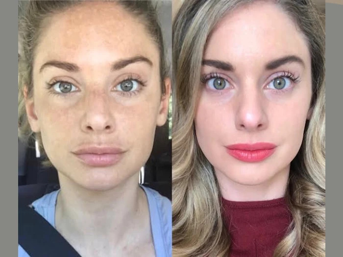 Radiofrequency Microneedling treatment in Dubai