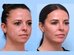 Thread Lift with Best Plastic Surgeons in Dubai Precision