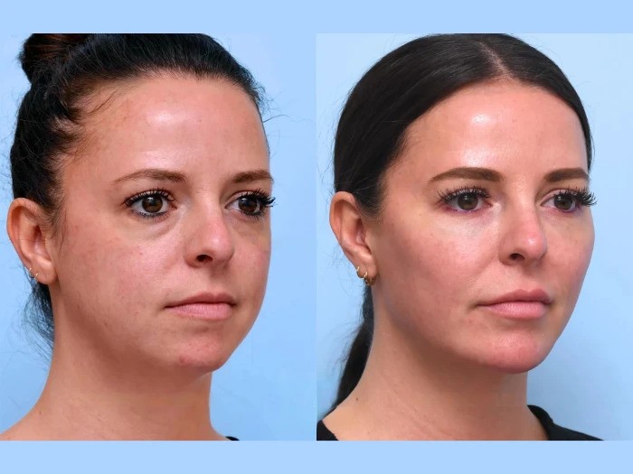 Best Plastic Surgeon in Dubai for Non Surgical Thread Lifts