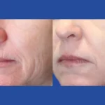 Fractional RF Microneedling in Dubai