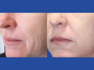 Fractional RF Microneedling in Dubai