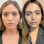 Thread Lift Performed by Best Plastic Surgeons in Dubai Specialists Treatments