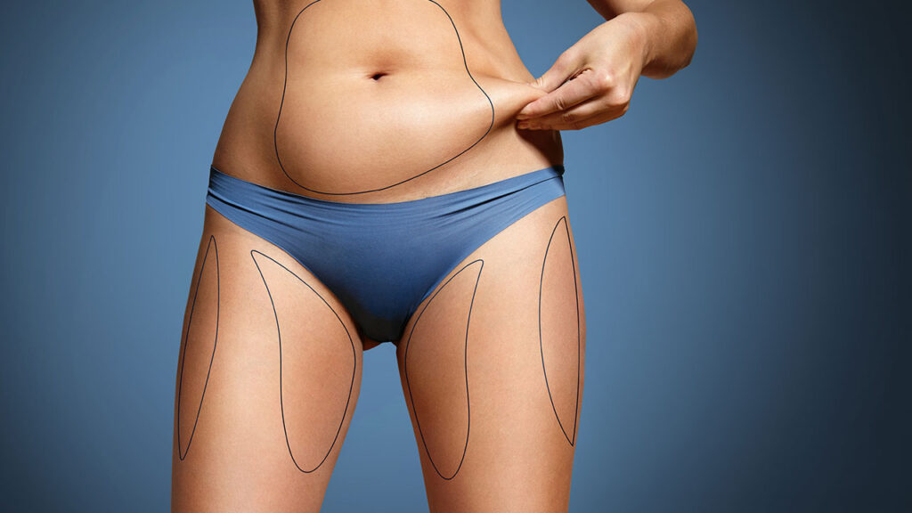 How Is Body Jet Liposuction Different From VASER