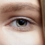 How Is Eyelid Surgery Performed for Upper Lids