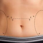 How Liposuction Surgery Targets Resistant Fat Cells