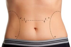 How Liposuction Surgery Targets Resistant Fat Cells