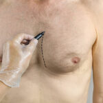 How Long Does Gynecomastia Surgery Recovery Take