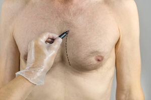 How Long Does Gynecomastia Surgery Recovery Take