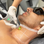 How beard laser hair removal changes grooming