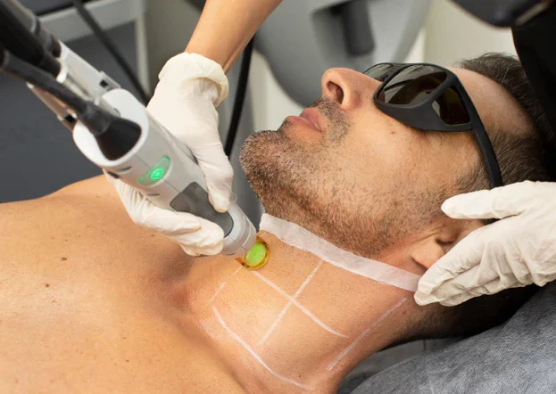 How beard laser hair removal changes grooming