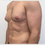 How to Identify Gynecomastia Early in Men