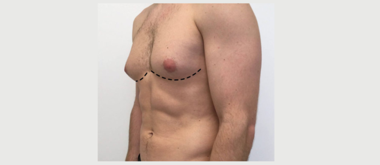 How to Identify Gynecomastia Early in Men