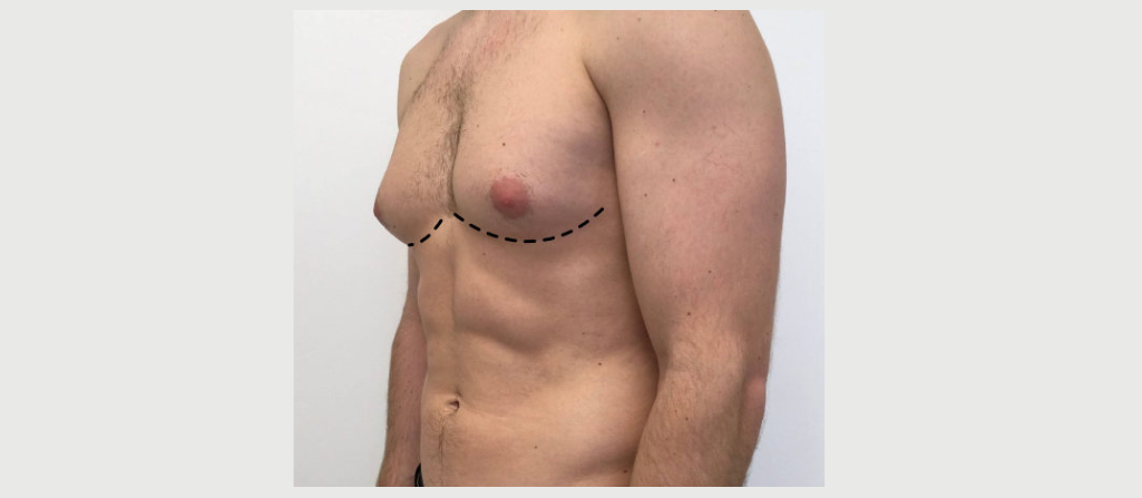 How to Identify Gynecomastia Early in Men