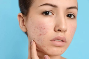 Is Acne Treatment Good for Sensitive Skin Types