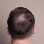 Is GFC Treatment for Hair Painful or Safe