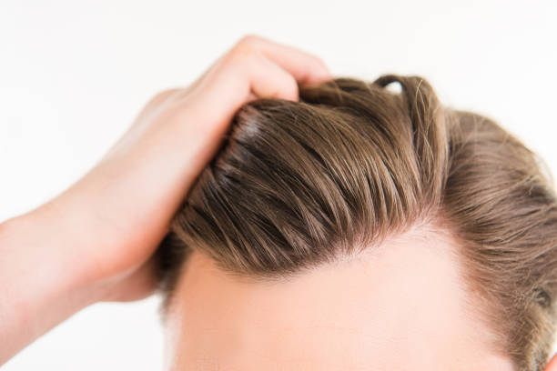 Is Hair Transplant Better Than Other Hair Loss Options