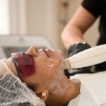 Laser For Rosacea In London