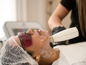 Laser For Rosacea In London