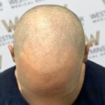 SMP Service for Bald Spots – Natural Hair Restoration Without Surgery