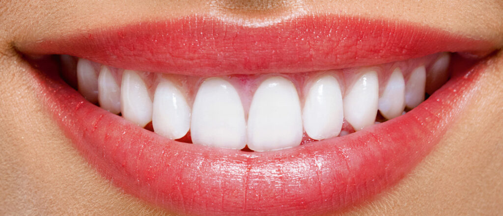 What E-Max Veneers Experts Recommend Most