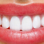 What E-Max Veneers Experts Recommend Most