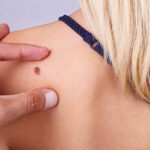 What Makes Skin Tag Removal So Popular