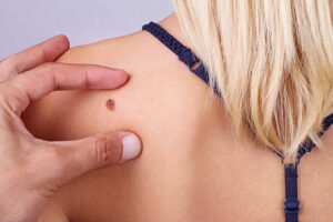 What Makes Skin Tag Removal So Popular