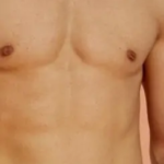 شفط الدهون في جدة