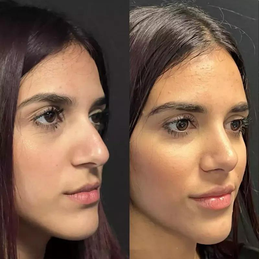 rhinoplasty in dubai