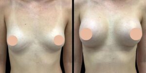 Breast augmentation in dubai