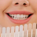 veneers-cosmetics-dubai