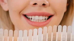 veneers-cosmetics-dubai