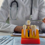 3D printed dental implant guide