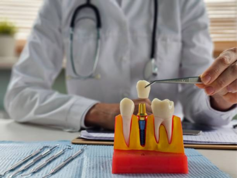 3D printed dental implant guide