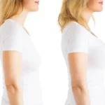 Breast Lift Dubai