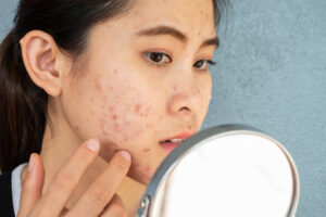 Can Acne Treatment Reduce Dark Spots Quickly