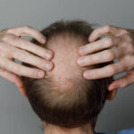 Can Hair Loss Treatment Improve Thin Hair Density