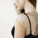 Can Vitiligo Treatment Restore Skin Color Fast