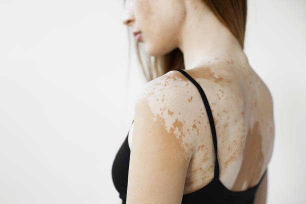 Can Vitiligo Treatment Restore Skin Color Fast
