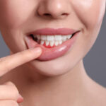Does Gum Recession Treatment Improve Smile Aesthetics