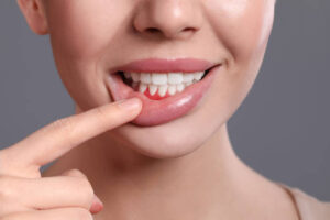 Does Gum Recession Treatment Improve Smile Aesthetics