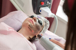 Does Laser Carbon Peel Shrink Large Pores