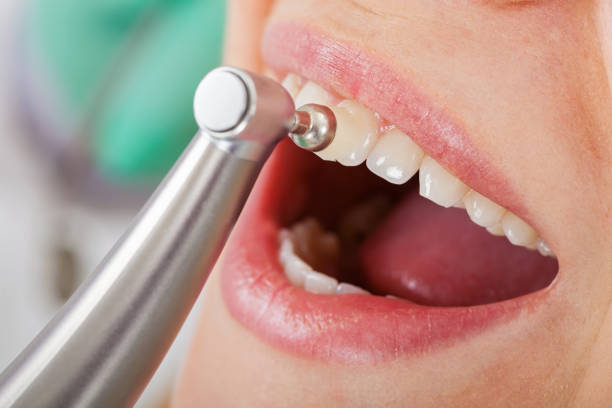 Does Teeth Cleaning Remove All Plaque Effectively